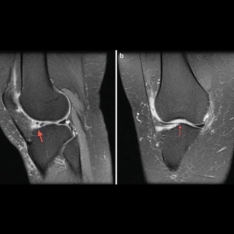 Knee Injury Meniscus Tear Physiotherapy Bondi Junction Sydney Physio